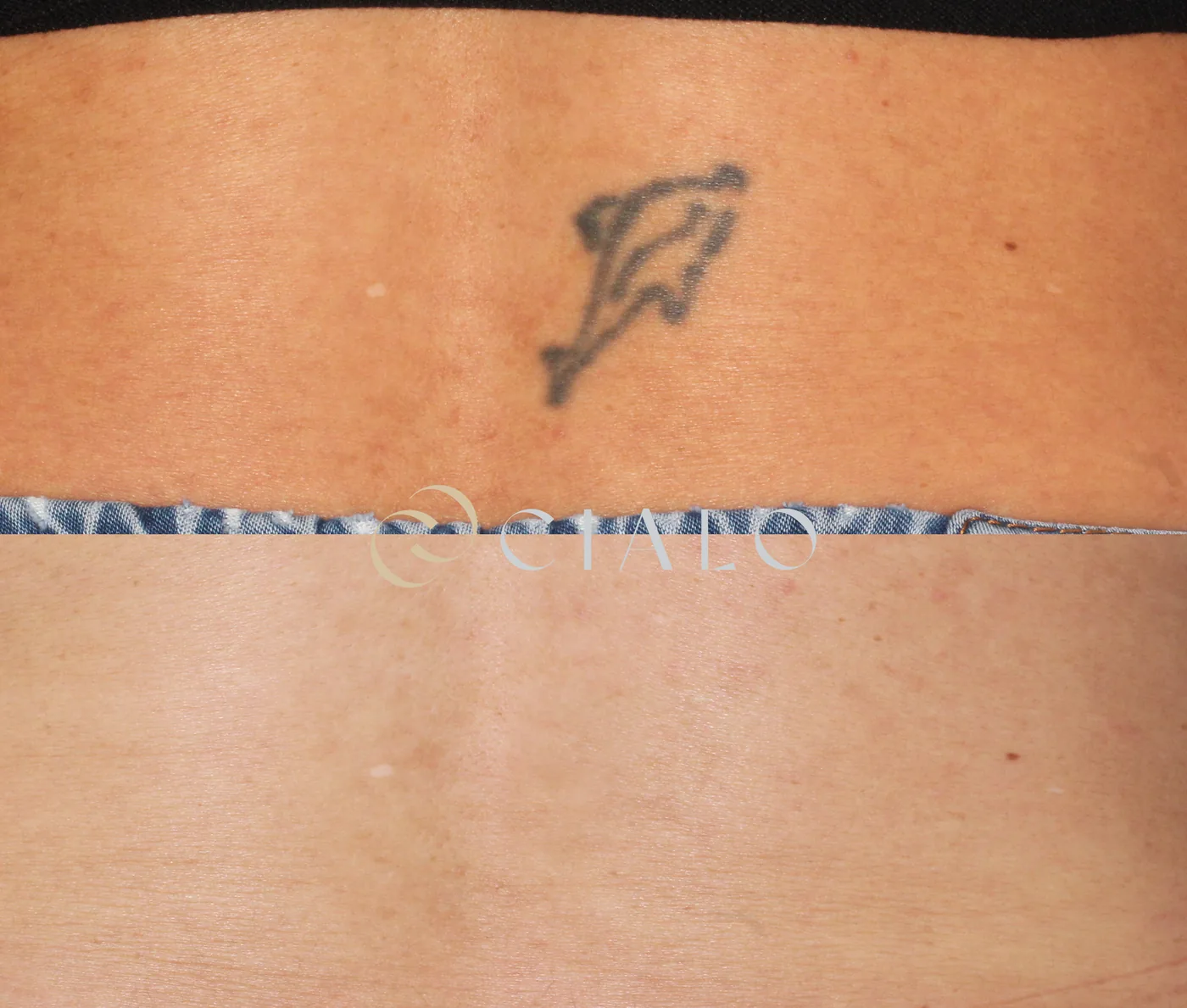 Borrado de Tatuajes — tratamiento de corporal en Clínica Cialo, Los Ángeles