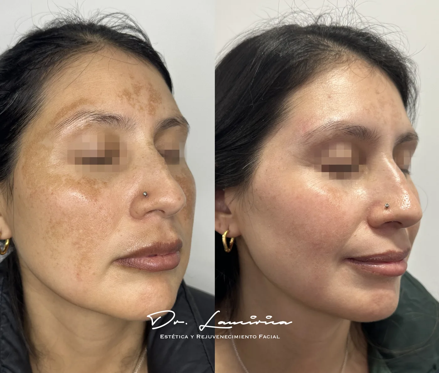 Tratamiento para Melasma en Clínica Cialo — imagen 6
