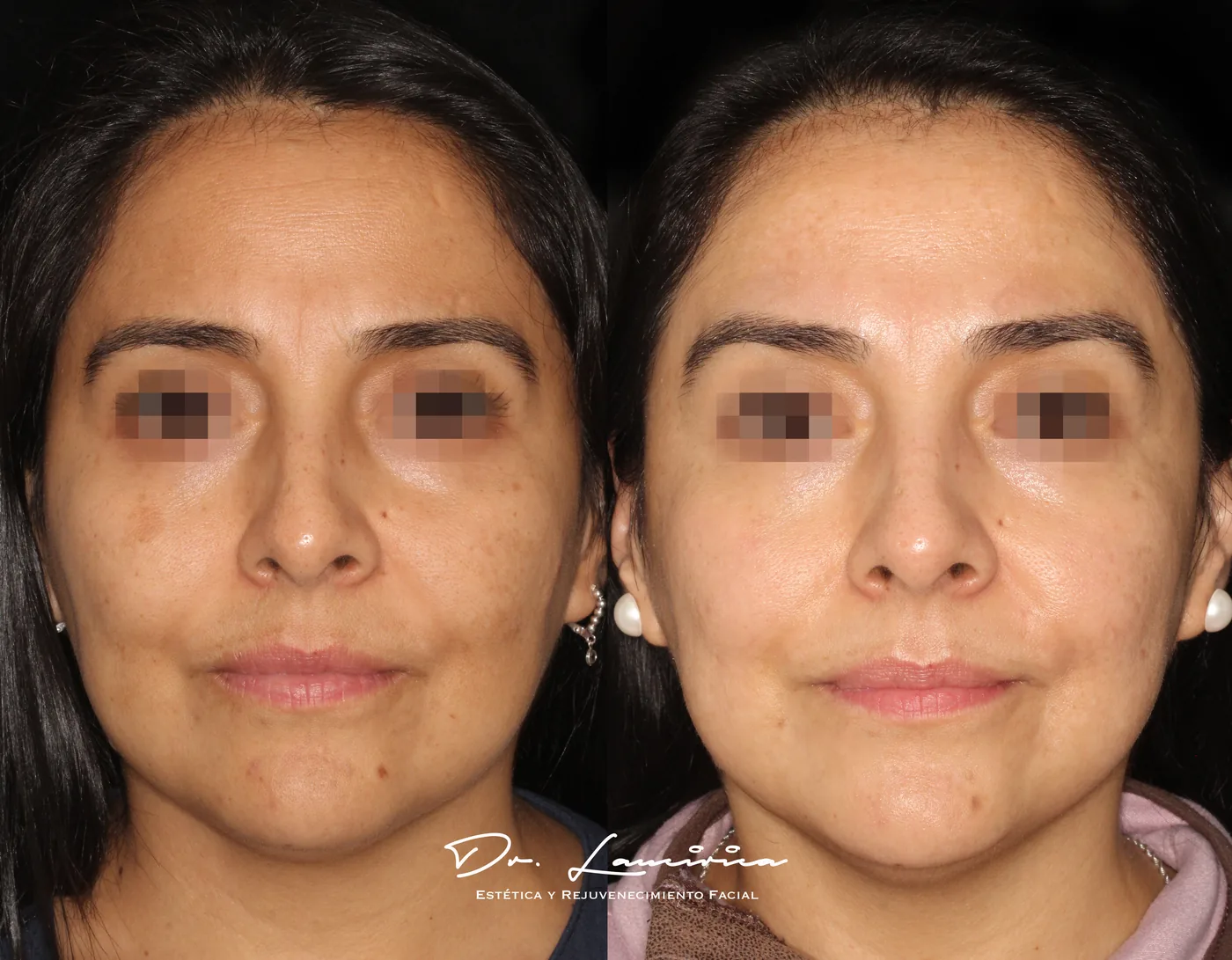 Tratamiento para Melasma — tratamiento de facial en Clínica Cialo, Los Ángeles