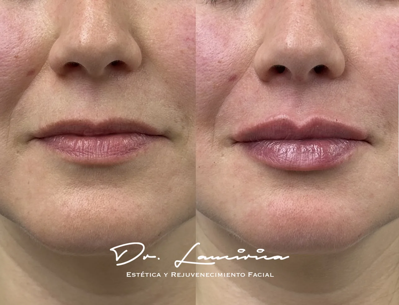 Relleno de Labios en Clínica Cialo — imagen 4