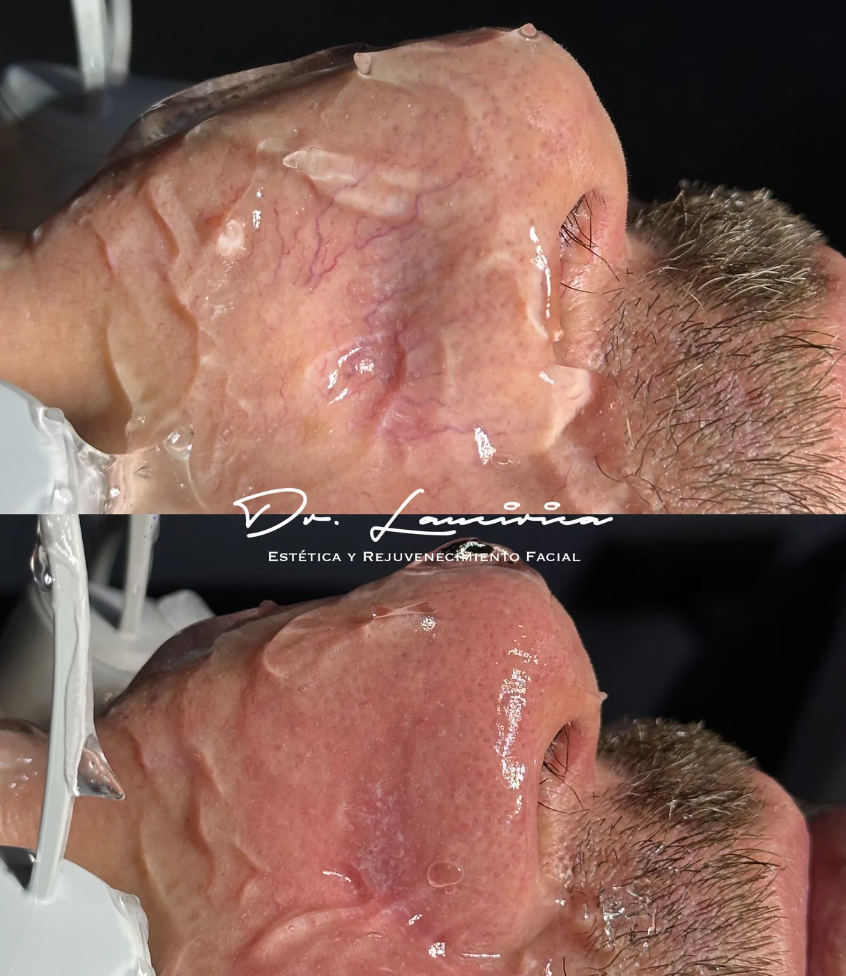 Tratamiento para Rosácea — tratamiento de facial en Clínica Cialo, Los Ángeles